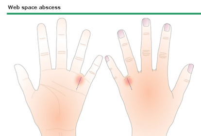 Hand Infection Incision