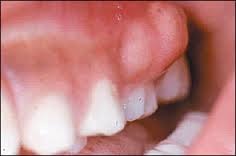 Ent Mouth Disorders Oropharynx Nasopharynx Larynx Trachea No