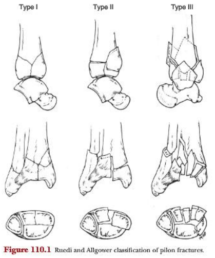 Mcglamry S Ch 110 Pilon Fractures Mcglamry S Flashcards