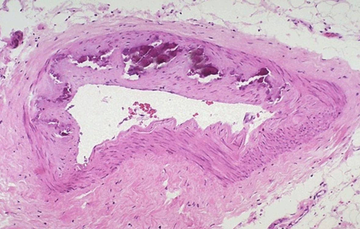 Обызвествление сосудов. Атеросклероз сосудов гистология. Артериосклероз Менкеберга гистология. Атеросклероз микропрепарат гистология. Атеросклероз аорты патанатомия.