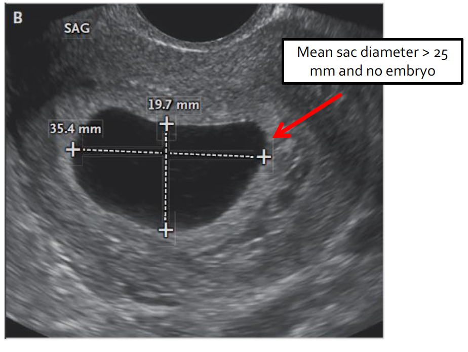 Non Viable Pregnancy Meaning - PregnancyWalls