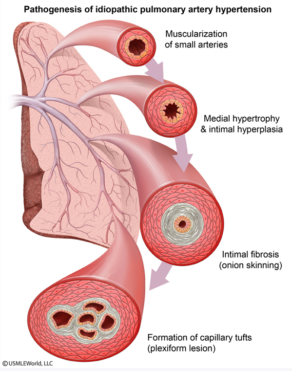 hipertansif damarlar genişler veya daralır