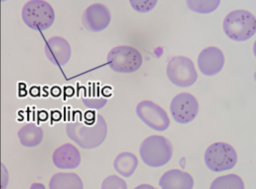 Image result for basophilic stippling sideroblastic anemia