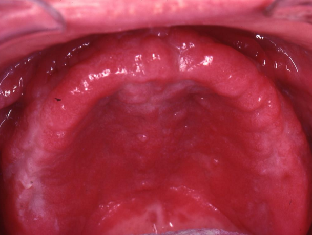 atrophic candidiasis