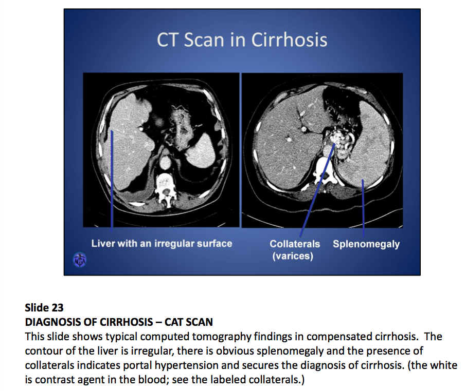 Fatty Liver Ct Scan Of Liver Cirrhosis Herbs And Food Recipes