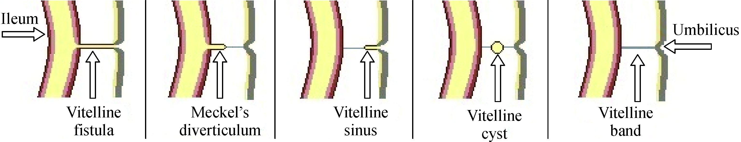 Image result for vitelline cyst