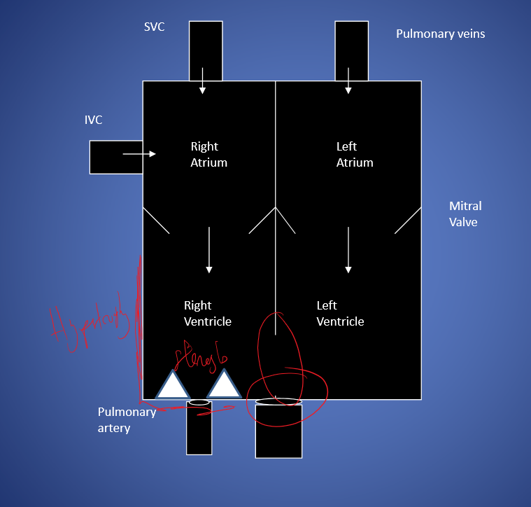 Overriding Of Aorta Definition