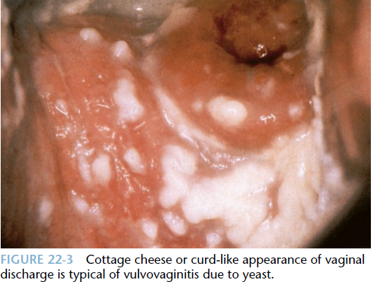 Microbiology 3 Vaginal Infections Carty Repro Flashcards