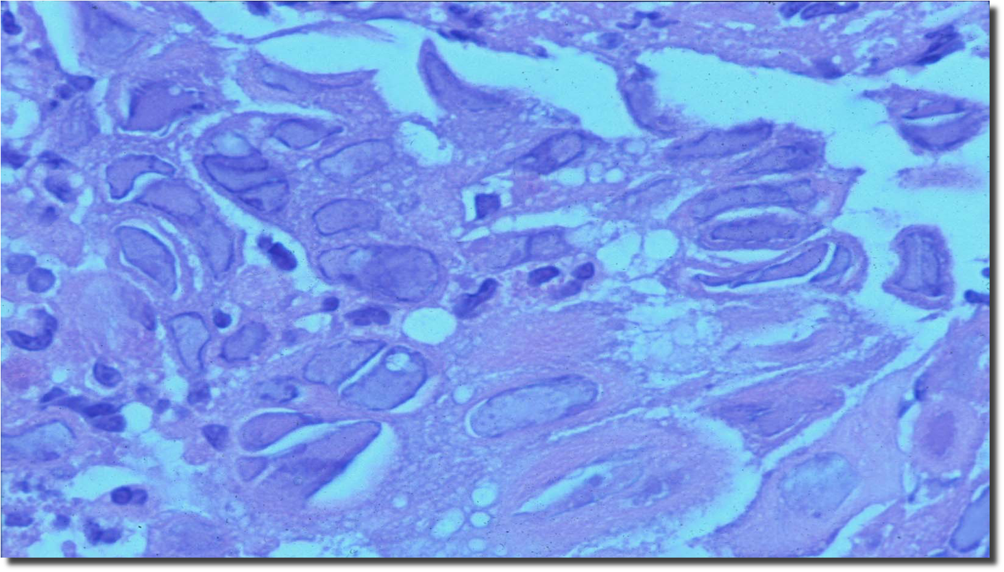 Gi Pathology Of The Esophagus Pathology Of Esophagus Flashcards