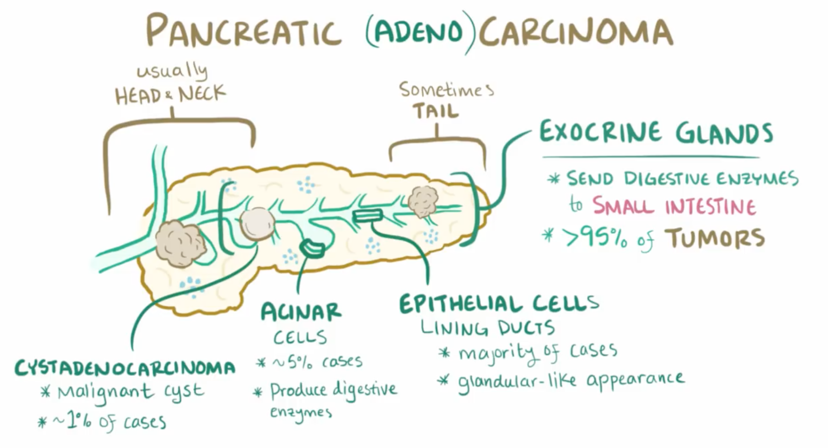 Pancreatic Cancer (GI) Flashcards | Memorang