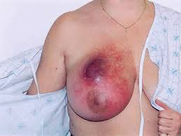 Inflammatory Breast Cancer (Breast) Flashcards | Memorang