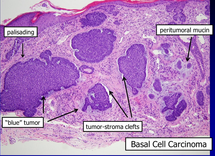 Skin Pathology Cancers B6 Flashcards Memorang