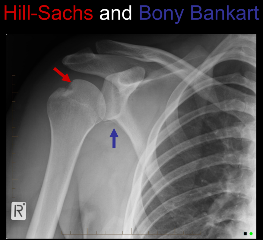 Разрыв плечевой кости. Перелом Хилл-Сакса плечевой. Перелом Хилл-Сакса рентген. Импрессионный перелом Хилл Сакса. Повреждение Хилл-Сакса плечевого сустава.