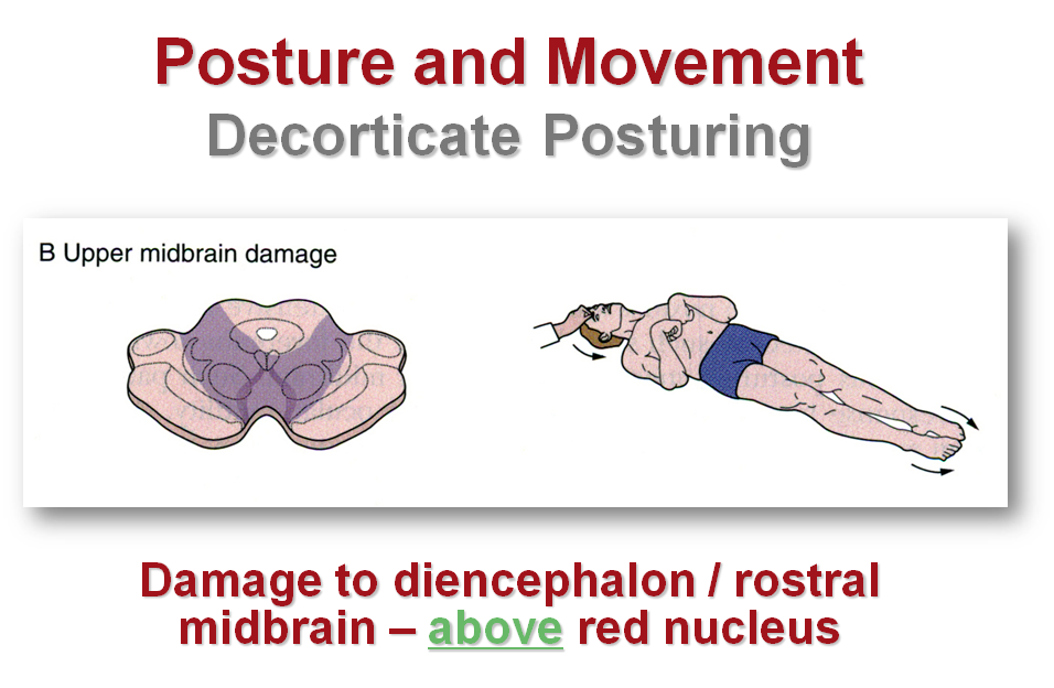 Article On Abnormal Posturing Standard Of Care