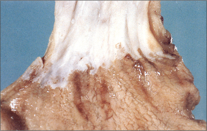 Pathology Of The Esophagus And Malabsorption Pathology Of The Esophagus And Malabsorption Flashcards Memorang