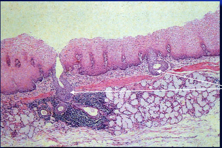 Foveolar Metaplasia Gallbladder Diet - Kiko & Miles