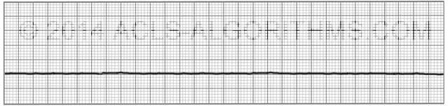 Sw Ohio Pulseless Rhythms Ekg For Asystole Pea Vt Vf Flashcards Memorang